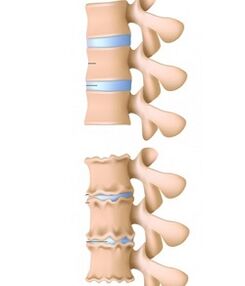 healthy spine affected by osteochondrosis