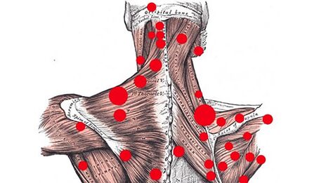 Trigger points in the muscles that cause myofascial back pain