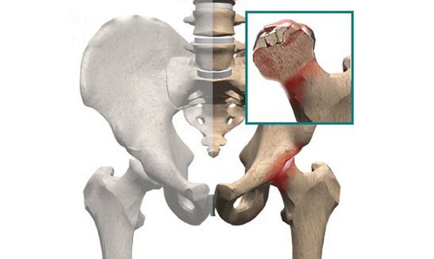Necrosis of the femoral head is one of the causes of pain in the hip joint. 