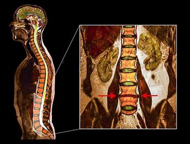 Degenerative disc in the column