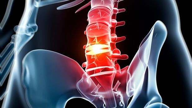 Lumbar column osteochondrosis