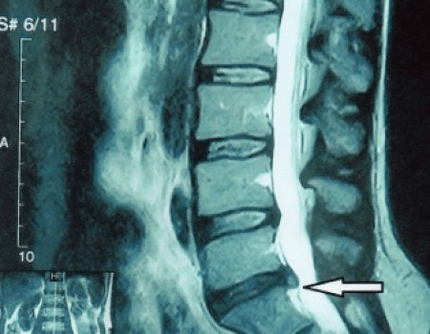 protrusion of a spinal disc on an MRI