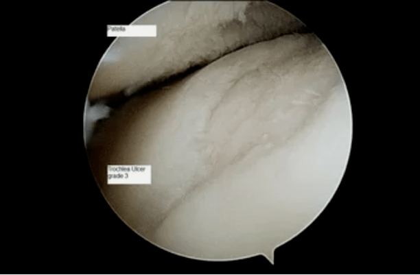 Astroscopic view of a knee joint with third degree osteoarthritis.