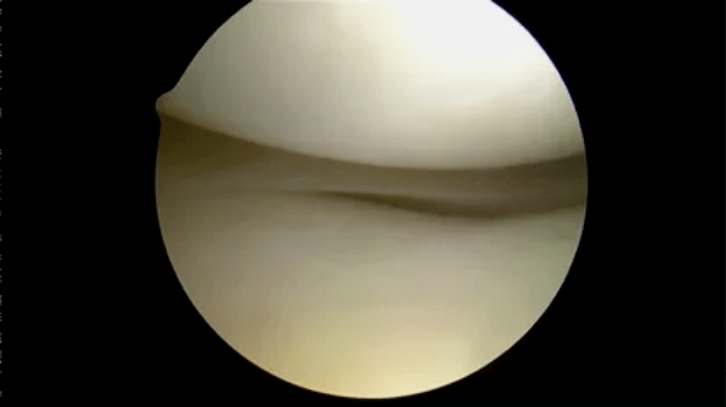 Astroscopic view of completely healthy surfaces.
