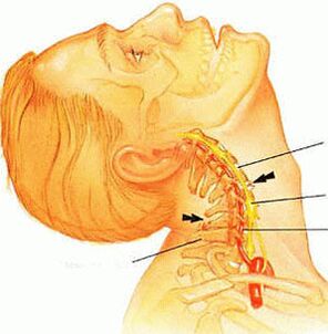 Osteochondrosis of the cervical spine.